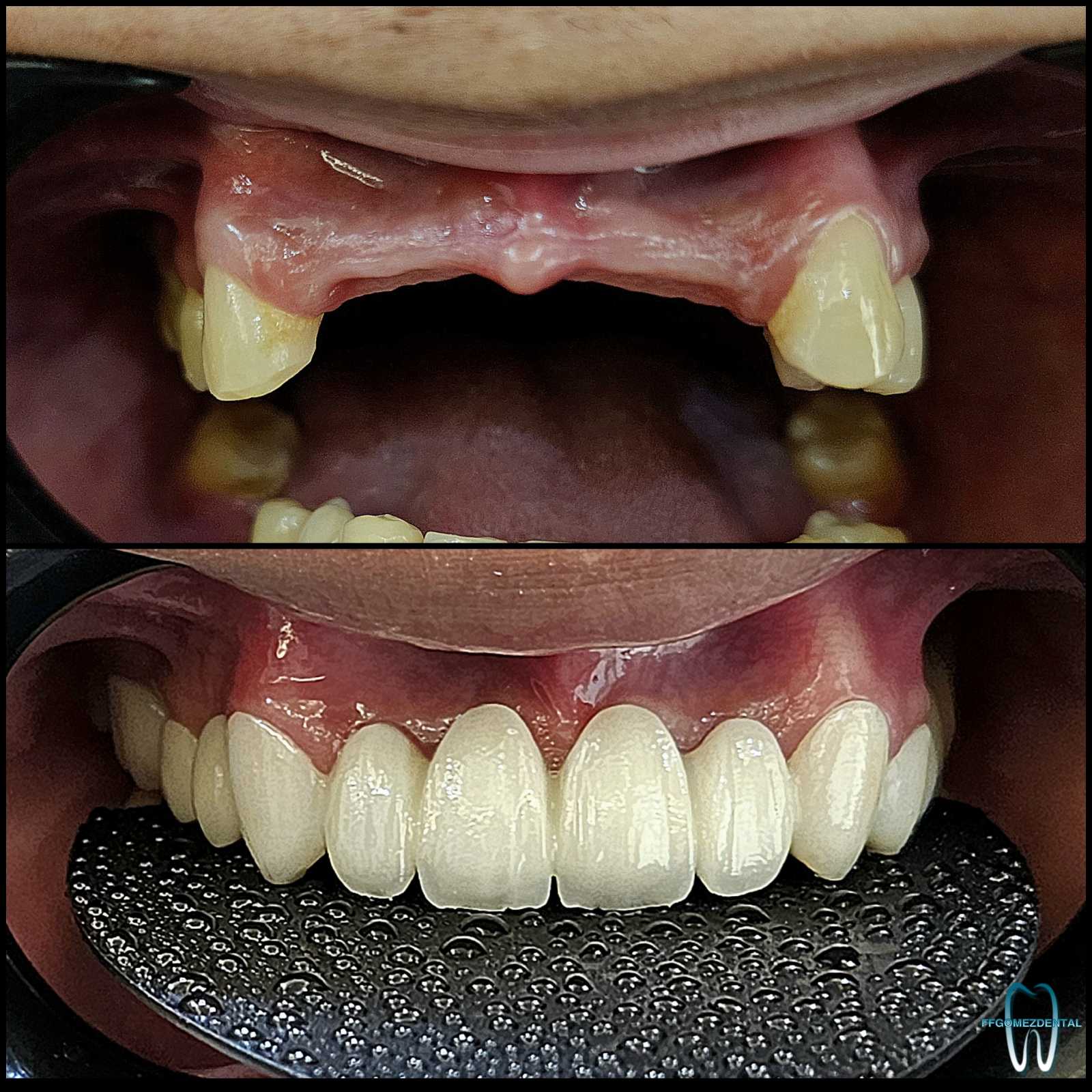 Fixed Bridge case 12 after treatment
