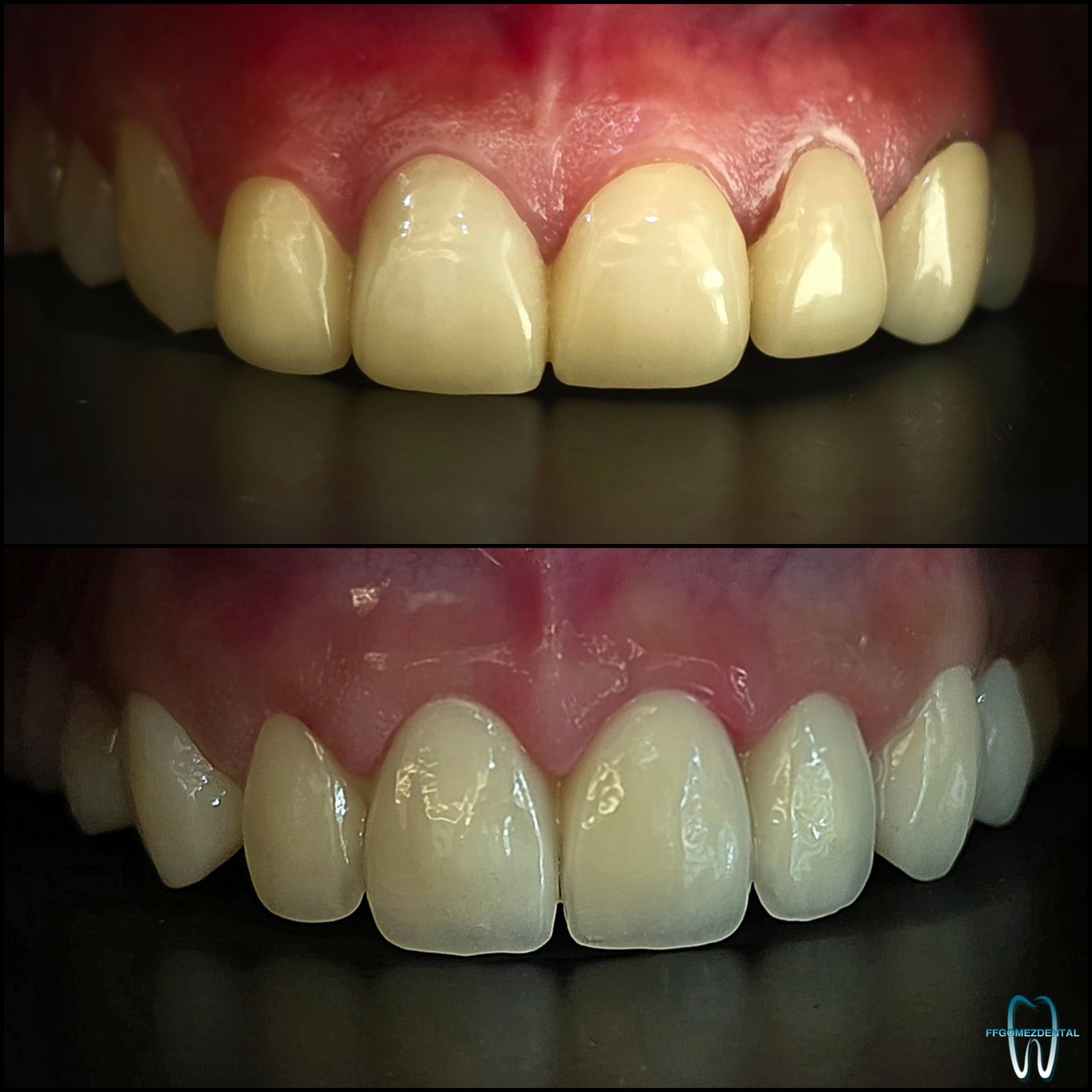 Jacket Crown case 11 after treatment