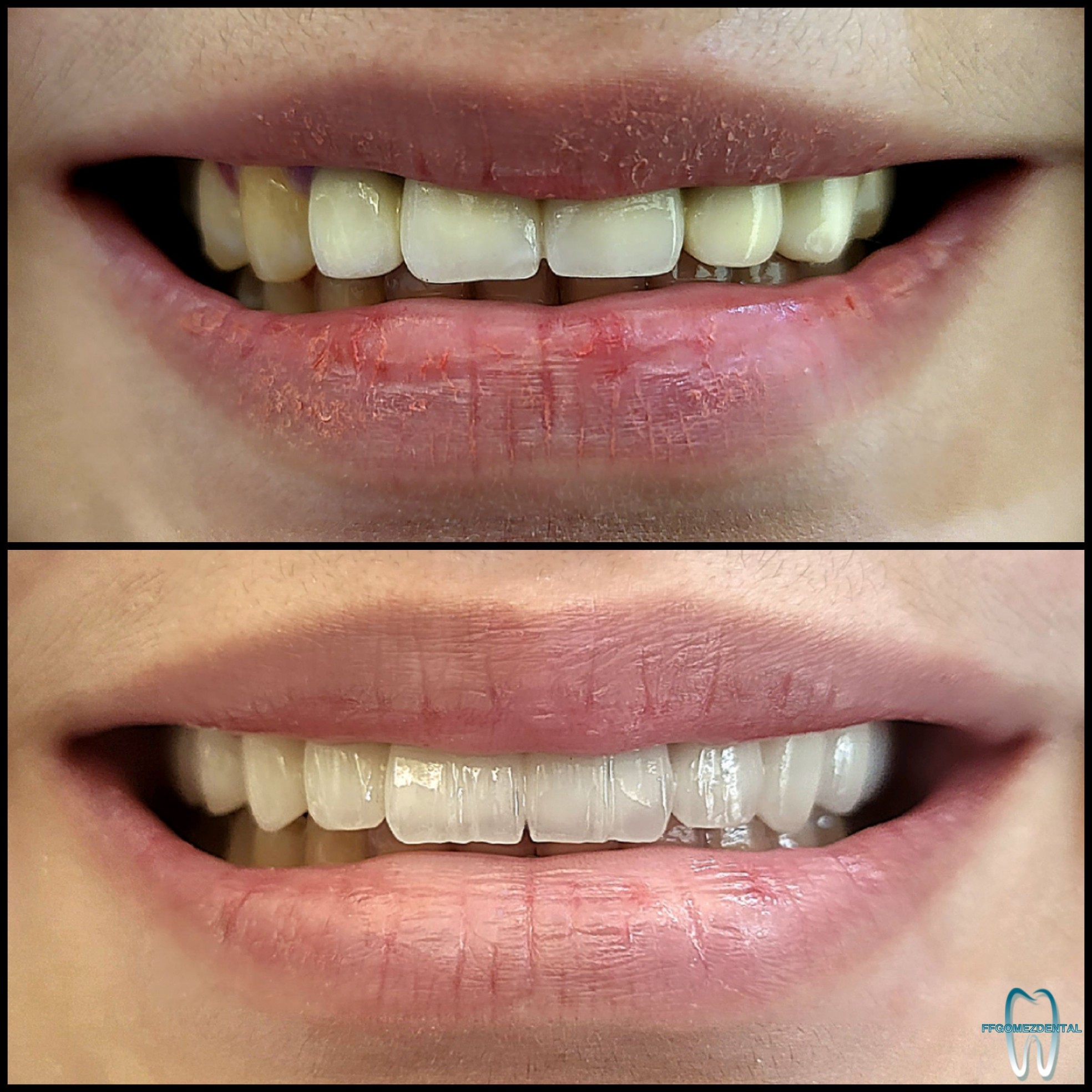 Fixed Bridge case 8 after treatment