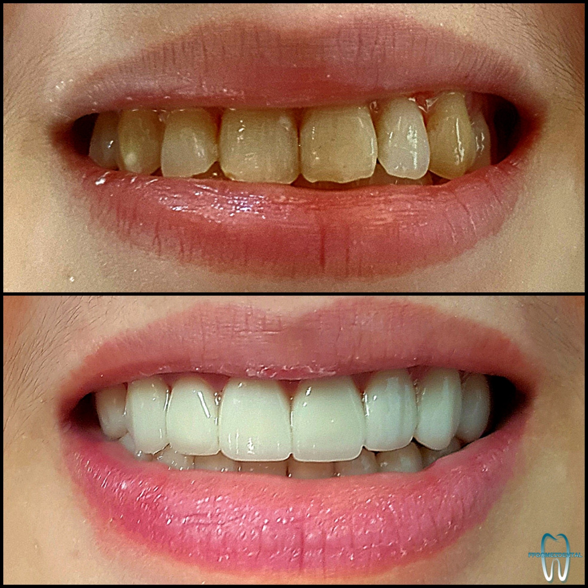 Veneers case 7 after treatment