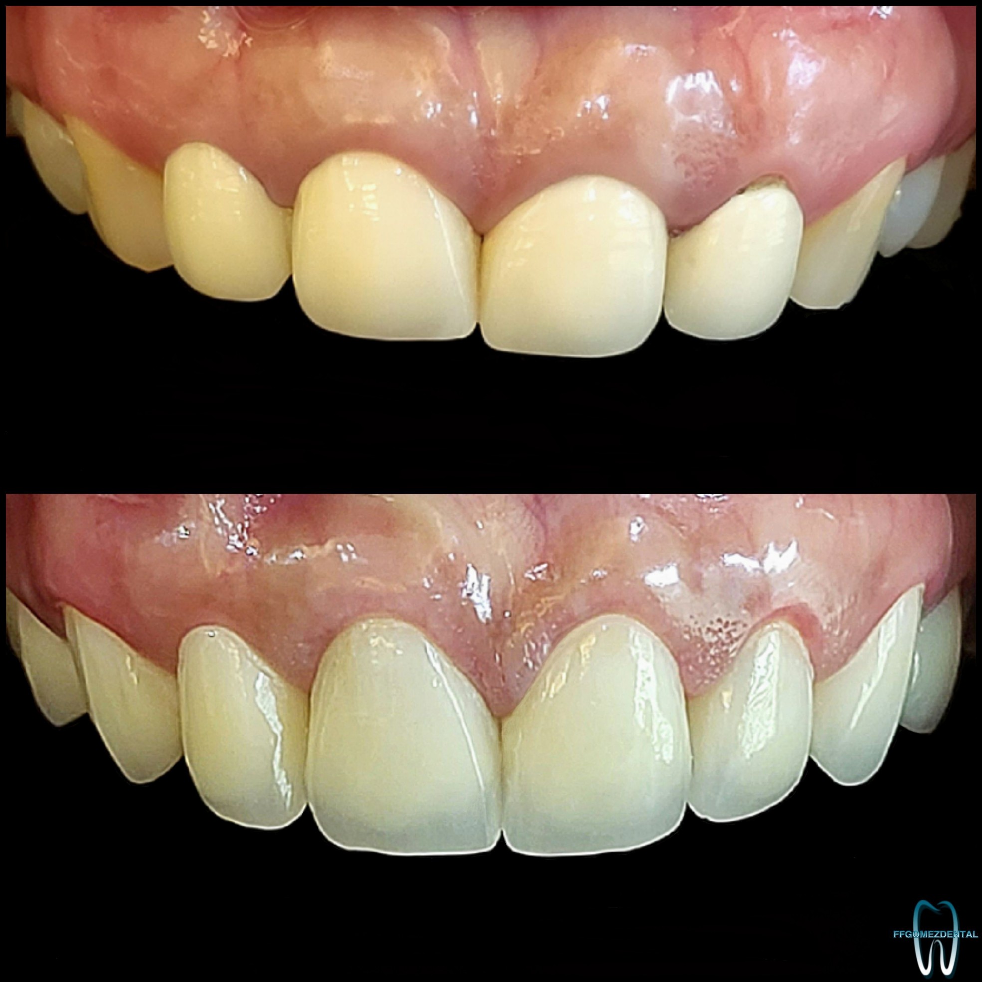 Jacket Crown case 7 after treatment