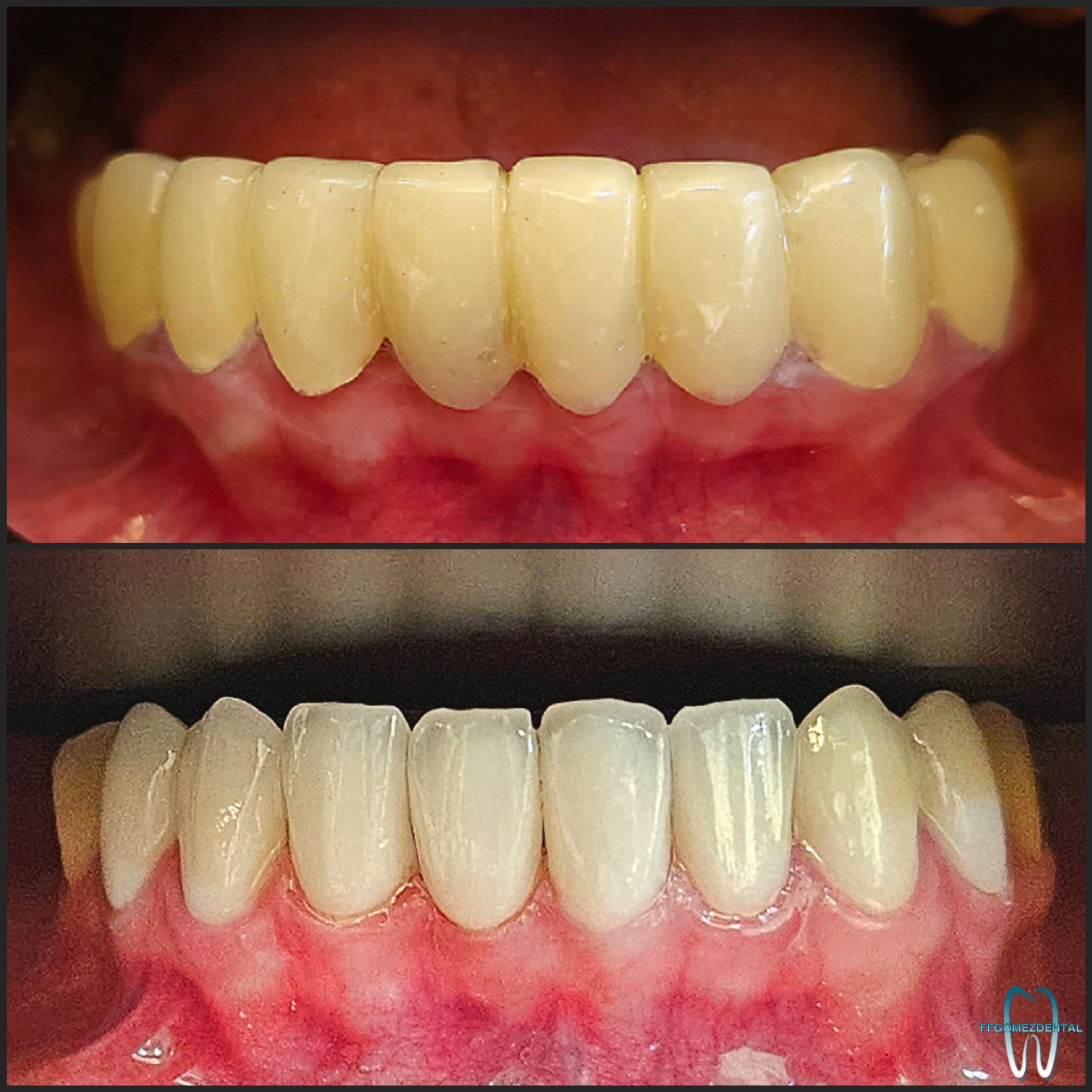 Veneers case 9 after treatment