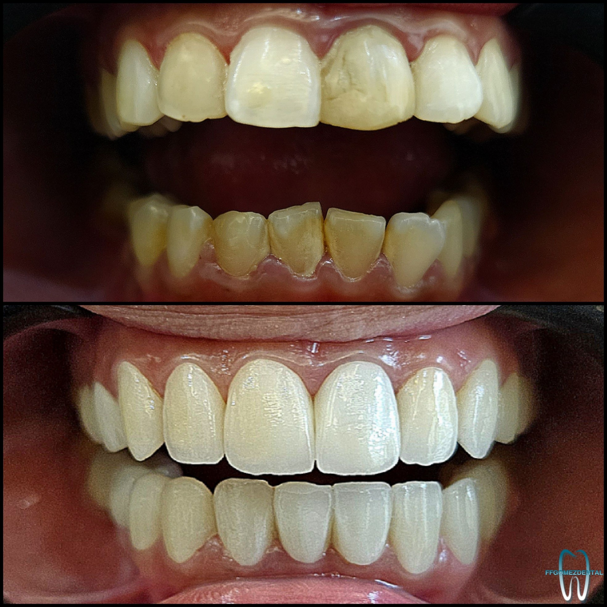 Veneers case 10 after treatment