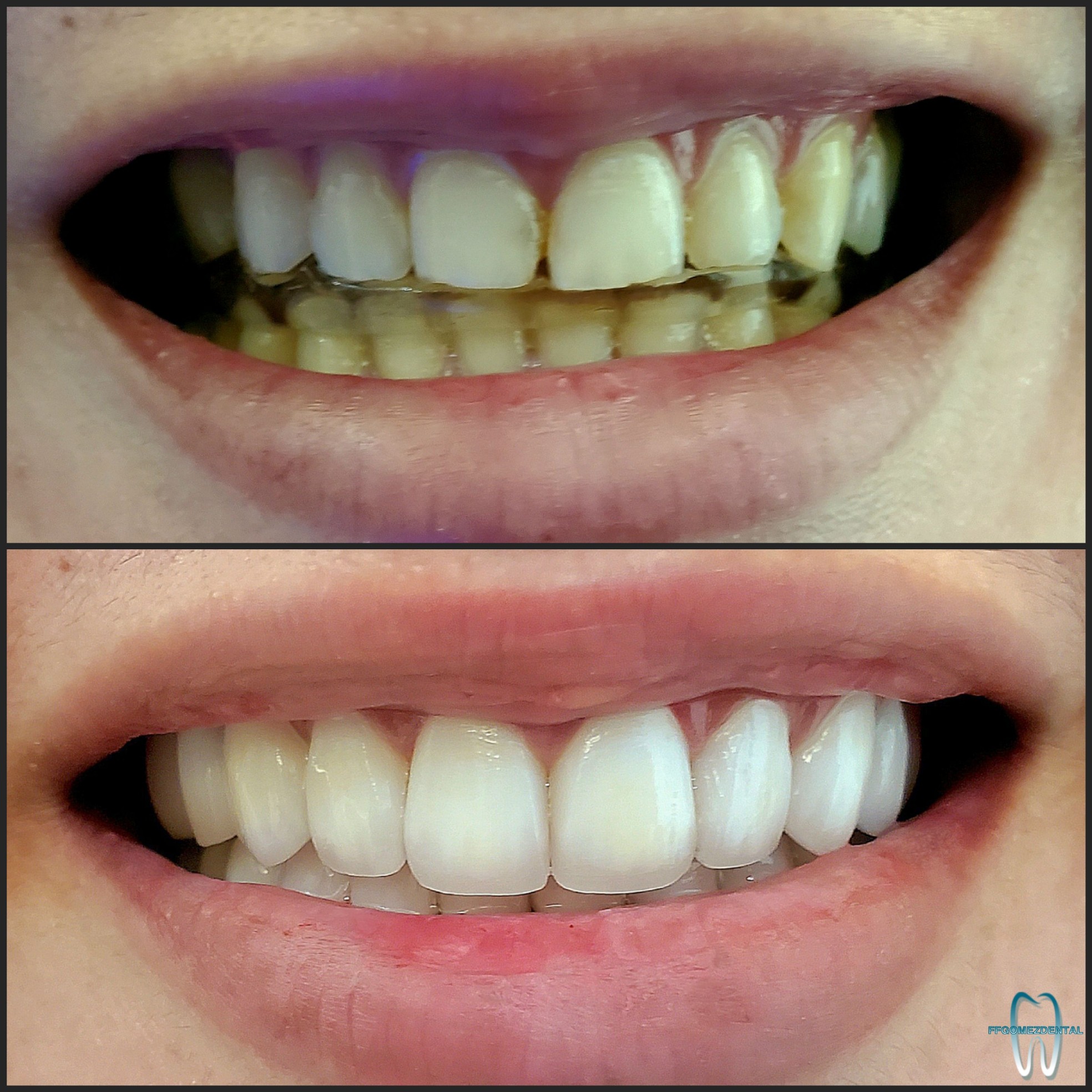 Veneers case 11 after treatment