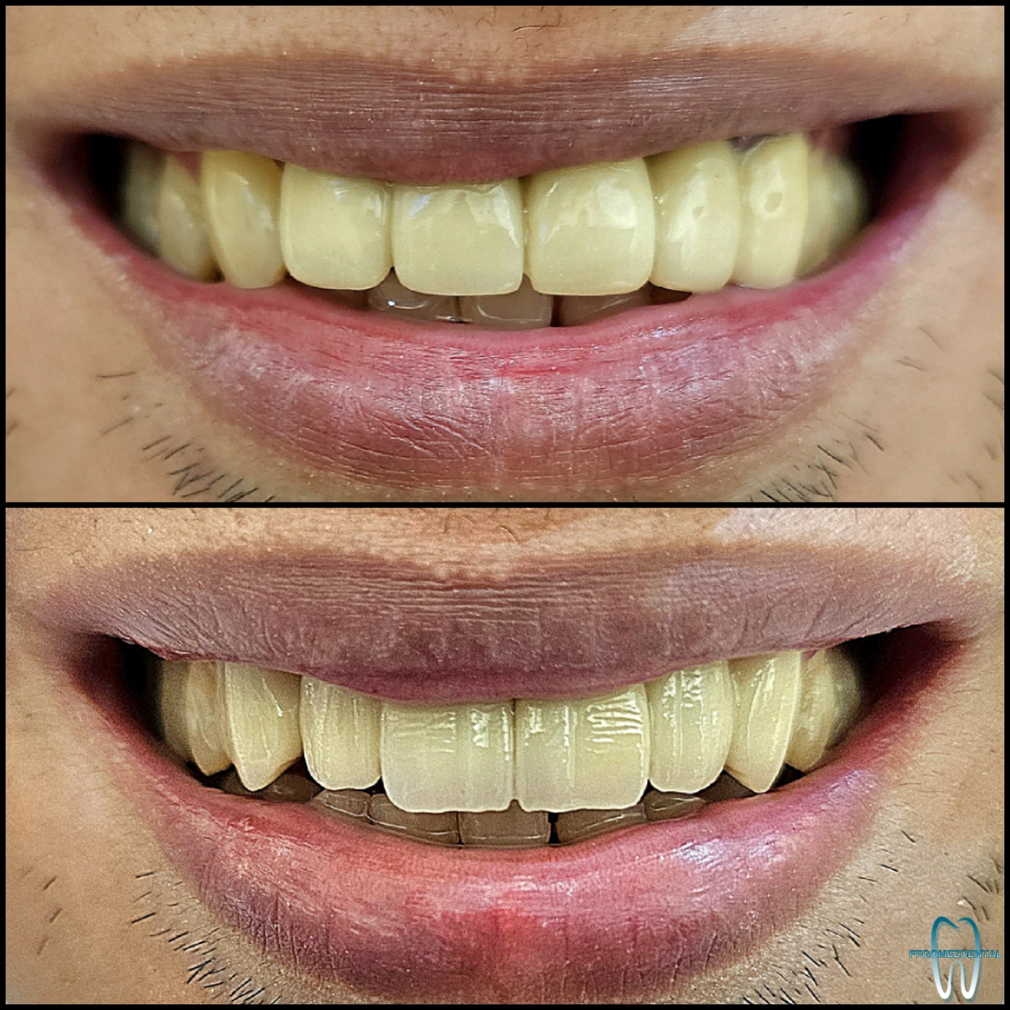 Fixed Bridge case 9 after treatment
